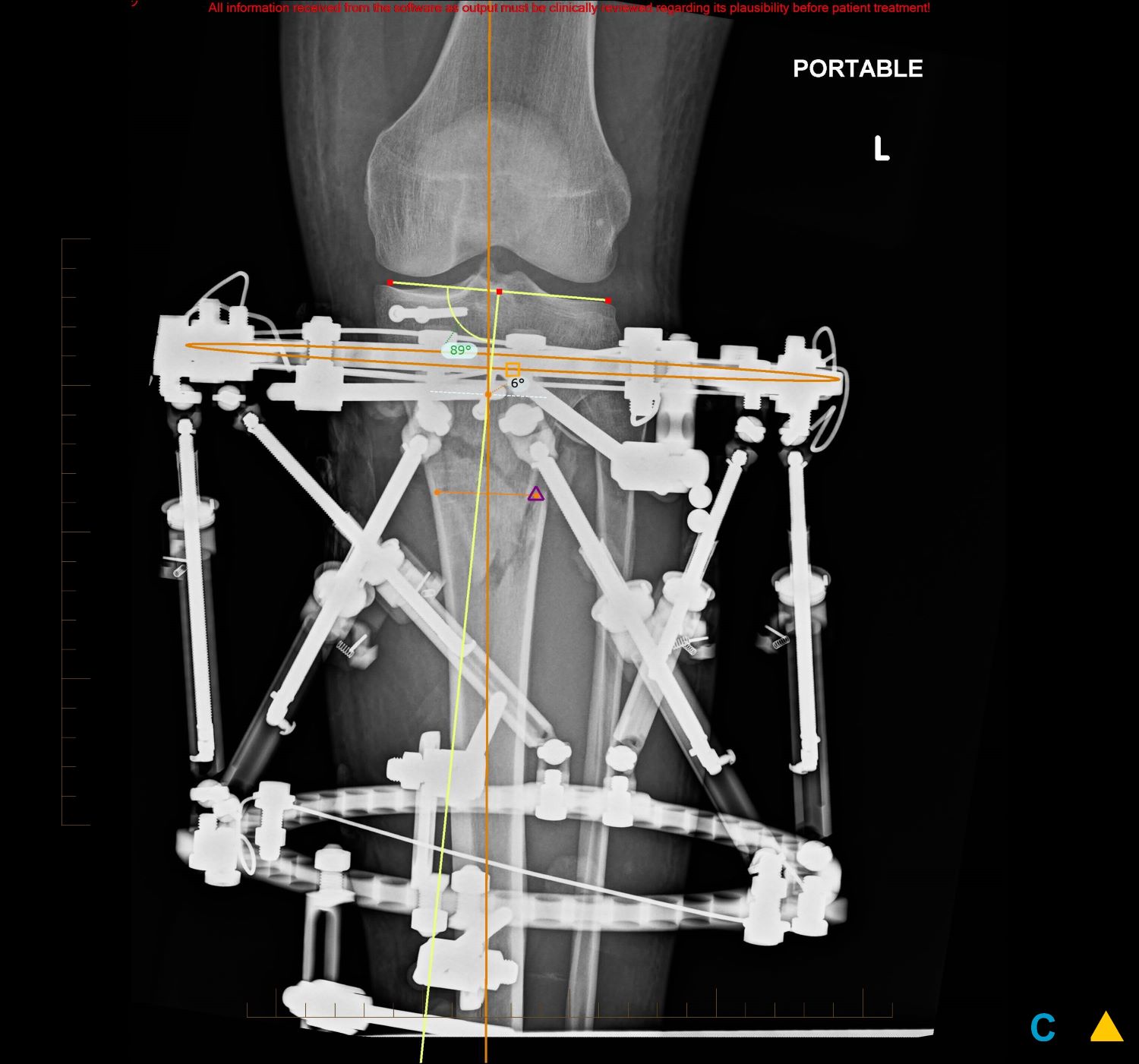 Lower Extremity Posttraumatic Reconstruction with Ring Fixation